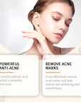 Calendula Anti-Acne Face Cream – Pore Shrinking Soothing Redness Oil Control Brightening Moisturizer